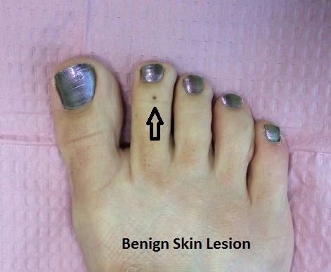 Benign Skin Lesion
