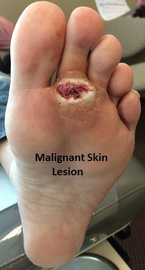 Malignant Skin Lesion