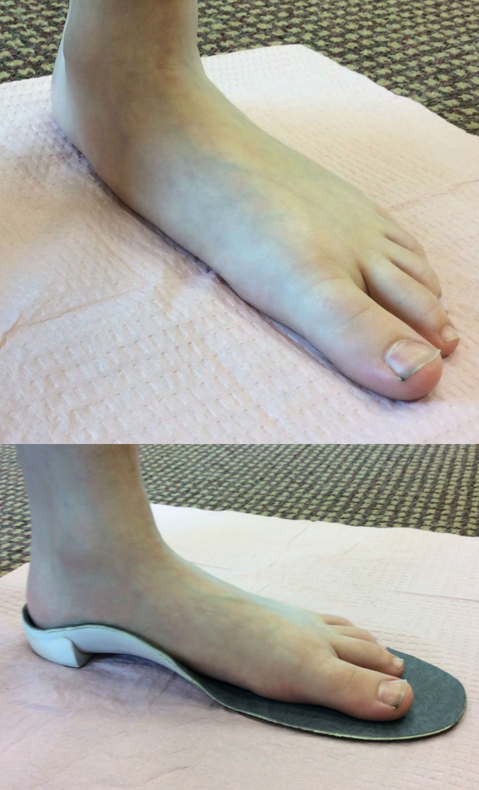 before & after orthotics