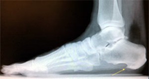 X-ray of foot with bone spur.