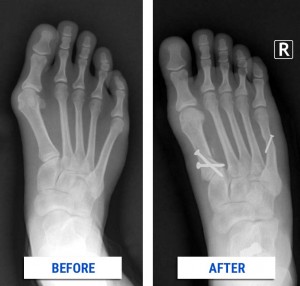 Before & after bunion surgery