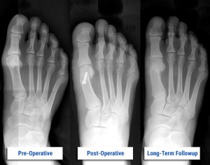 Before & After Bunion Surgery