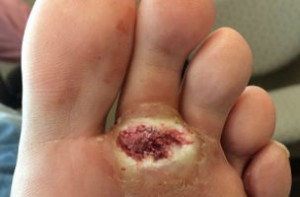Before & after bunion surgery photos