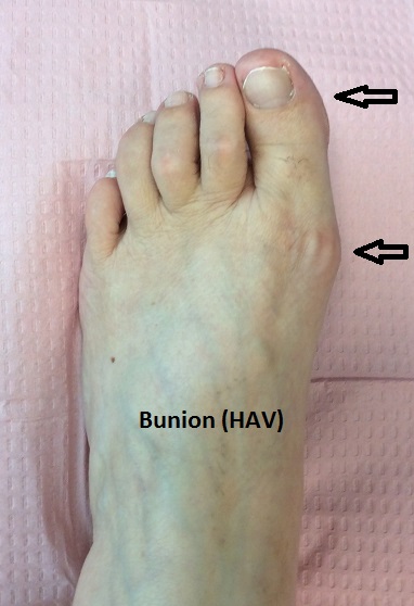 Bunion