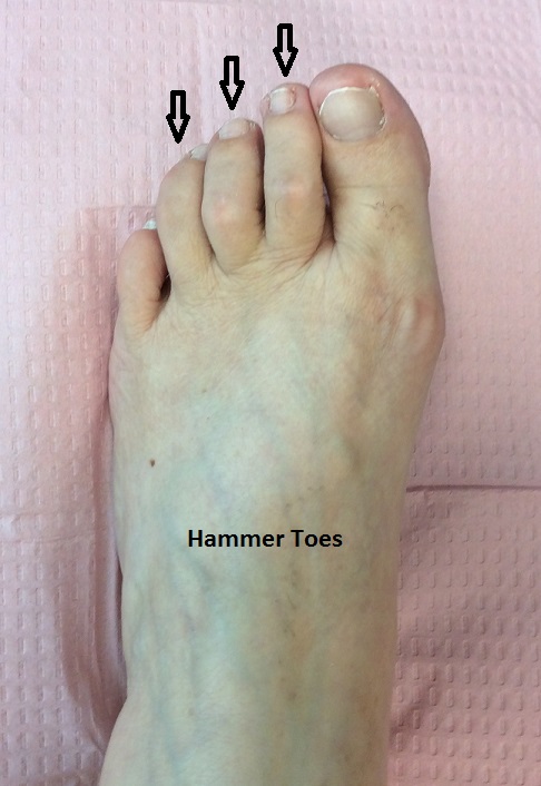 Hammer-Toe