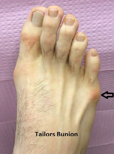 Tailors-bunion