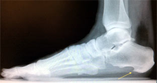 foot-xray