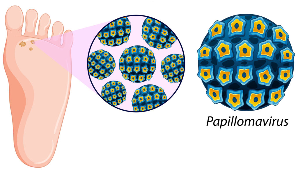 Human papillomavirus (HPV) illustration showing plantar warts on the bottom of the foot treated by podiatrists in Lake Zurich IL