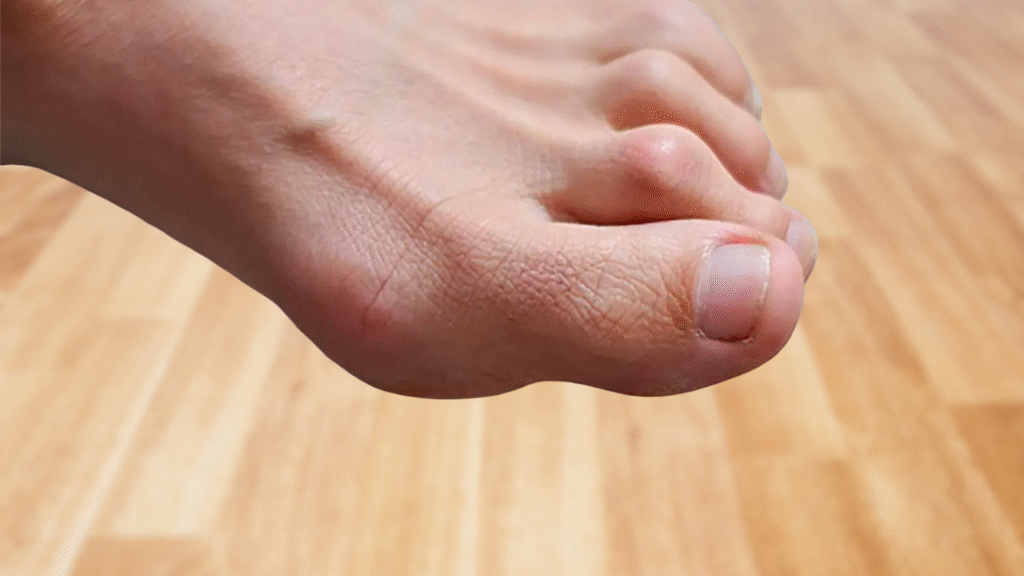 Hammer Toe Correction | Hammertoe deformity affecting the smaller toes shown on a patient at Alpine Foot Specialists in Lake Zurich, IL