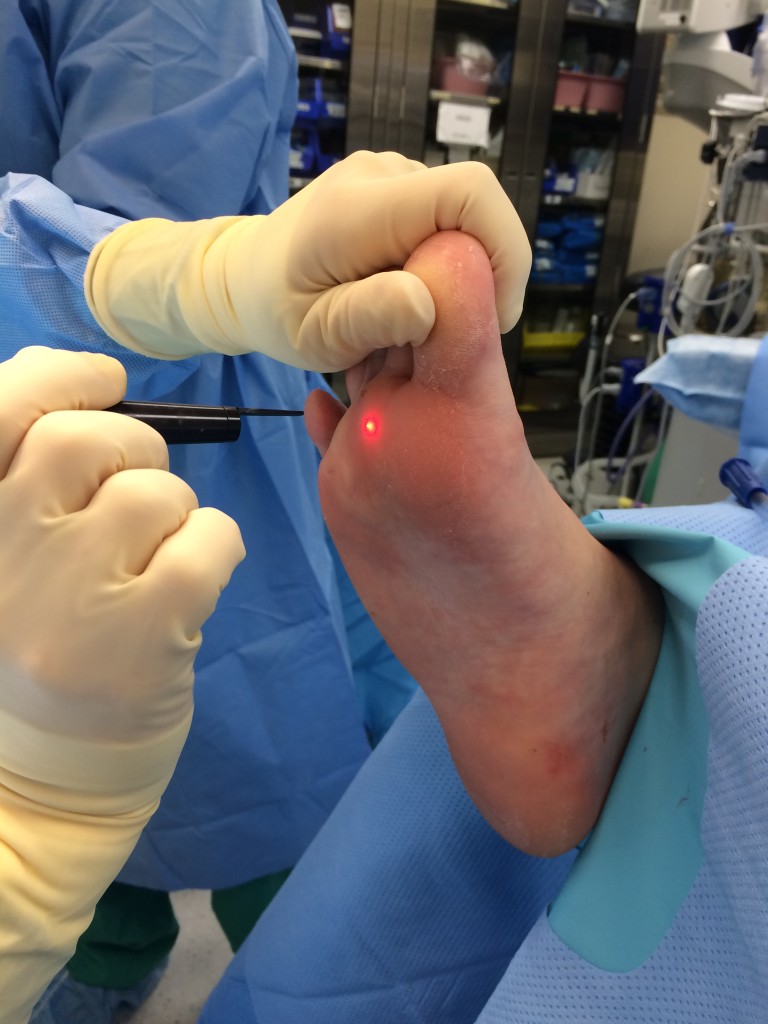 Laser wart removal procedure on the bottom of the foot performed in a sterile medical setting at Alpine Foot Specialists in Lake Zurich, IL