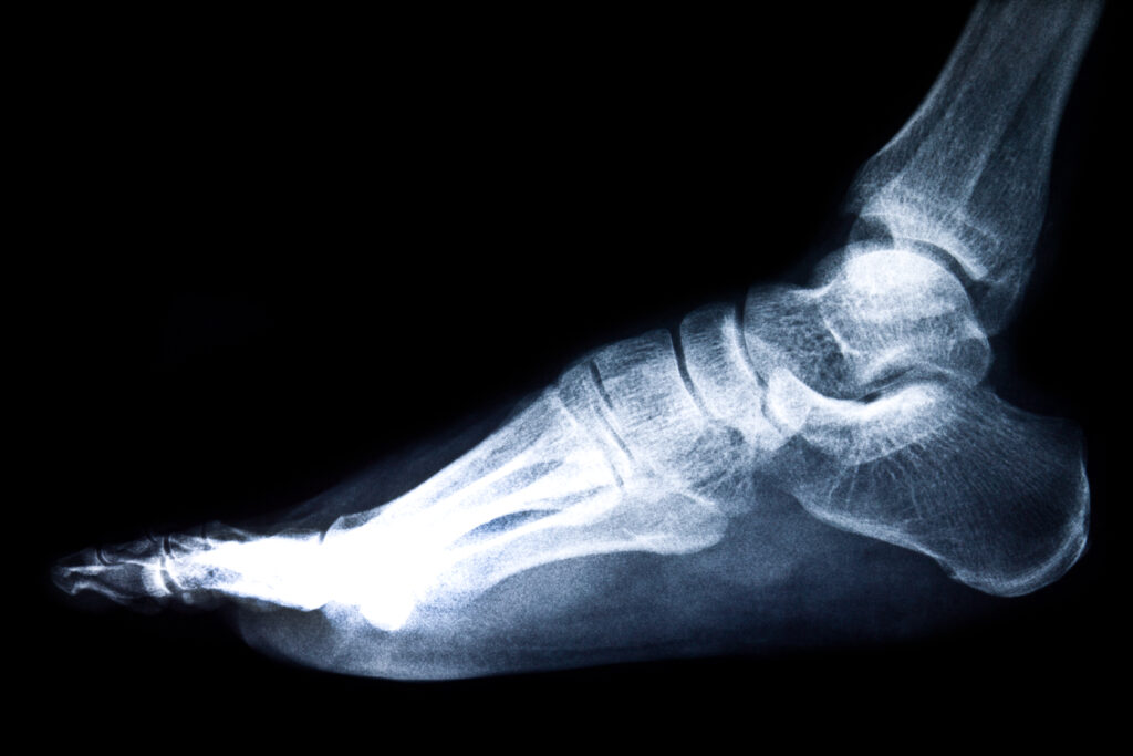 Lateral foot Digital X-Rays showing bones and arch structure for diagnostic evaluation