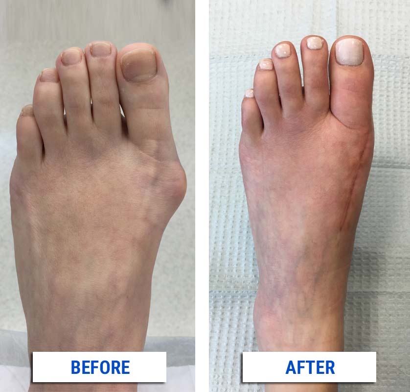 preview-full-Alpine-Before-After Bunion
