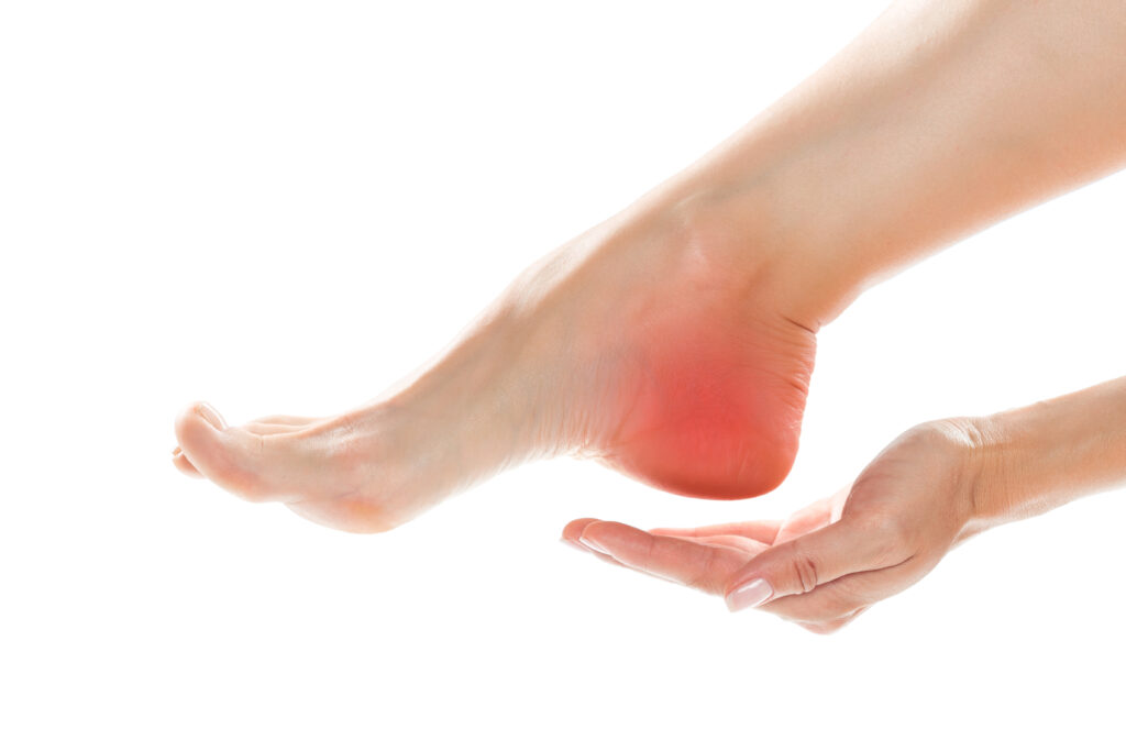 Heel pain and plantar fasciitis illustration showing inflammation in the heel area