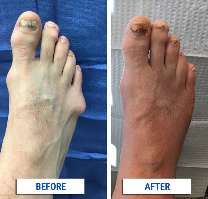 Bunion Correction