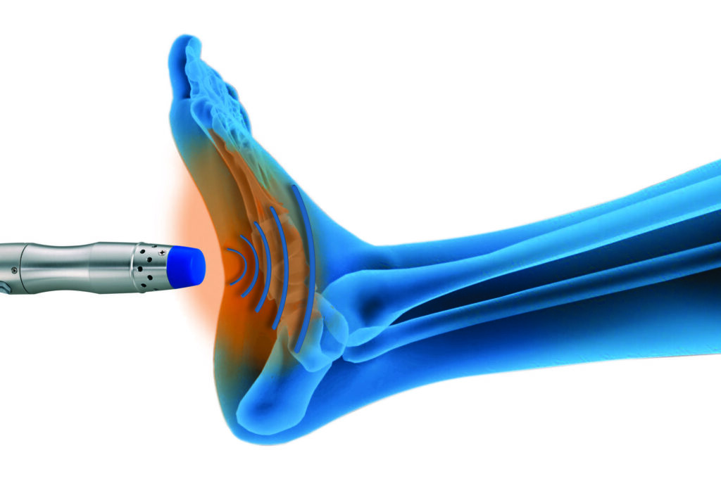 Radial shockwave therapy instrument targeting heel pain on a foot X-ray overlay