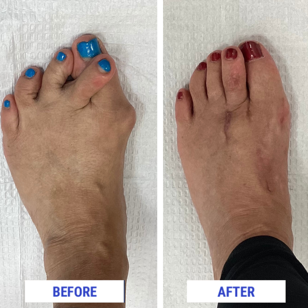 bunions-before-after-surgery