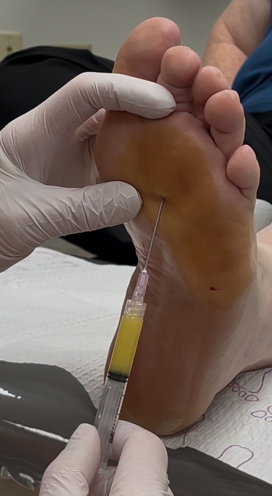 Fat pad restoration procedure at Alpine Foot Specialists
